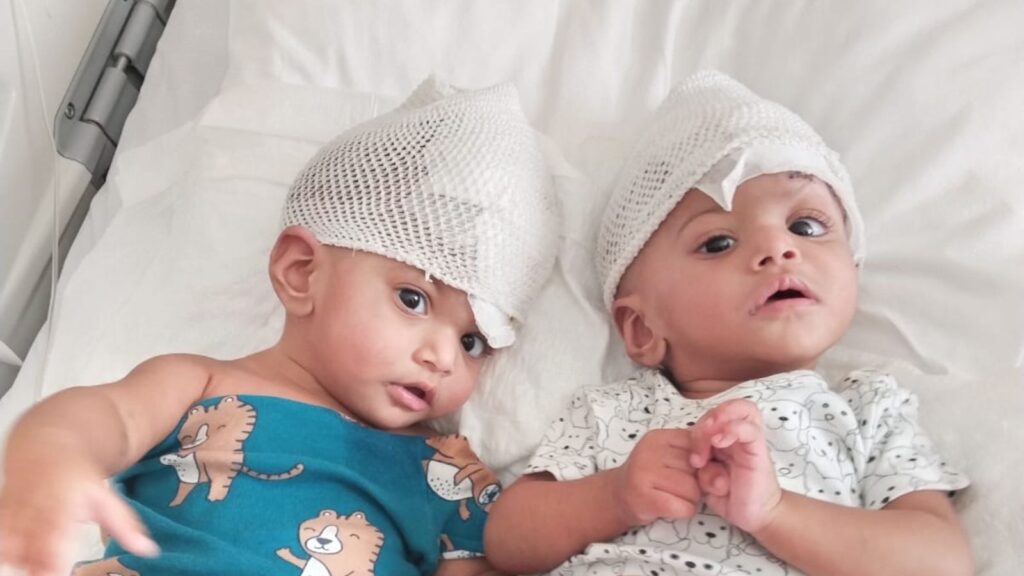 Conjoined one-year-old twin girls Minal and Mirha who were separated during an operation at Ankara Bilkent City Hospital in Turkey on 19 July 2024. Work was supported by Gemini Untwined, a charity founded by Professor Noor ul Owase Jeelani from Great Ormond Street Hospital. handout from charity