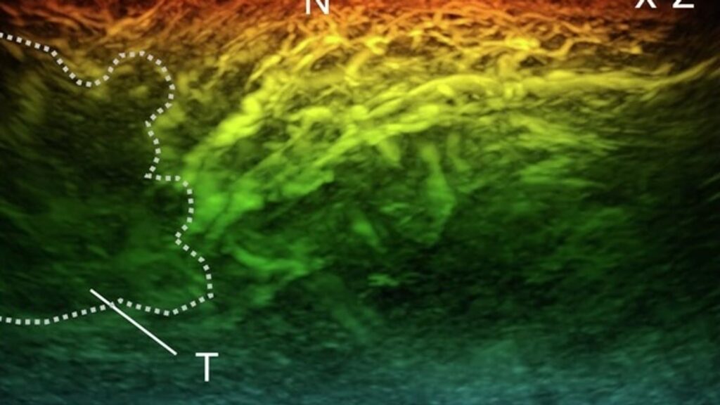 PAT scan of a presumed breast tumor. Pic: University College London