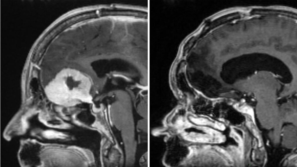 Scan of Doreen Adams head before (left) and after (right) an operation by consultant neurosurgeon, Anastasios Giamouriadis, to remove a brain tumour through her eyebrow. Pic: NHS Grampian