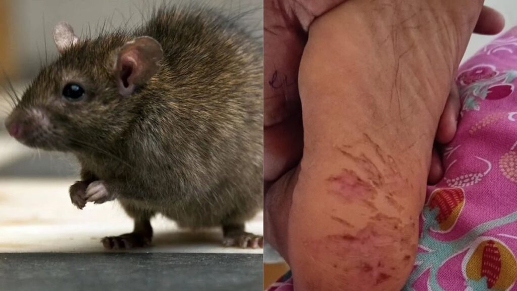 Telangana Shocker: Class X Girl Student Paralysed After Rats Bite Her 15 Times In 8 Months; Video