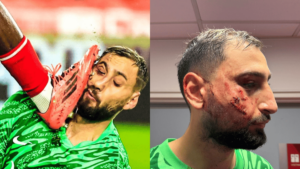 Bloody Face! PSG Goalkeeper Gianluigi Donnarumma Suffers Horrific Facial Injury During Match Against...